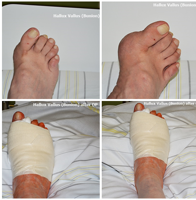 Hallux Vallus-before-after-OP